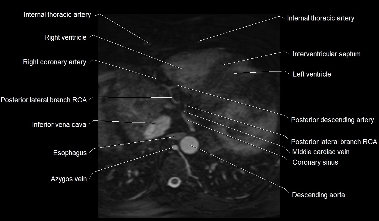 MRI heart coronary arteries and coronary veins anatomy axial image 39.webp